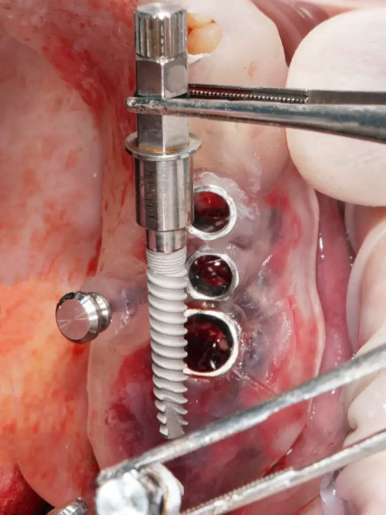 Dental implant procedure