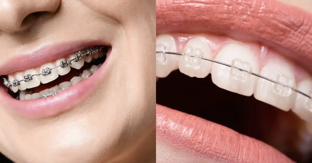 Close up of a person's teeth with braces that shows you can get braces over 50.