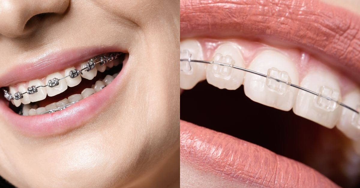 Close up of a person's teeth with braces that shows you can get braces over 50.