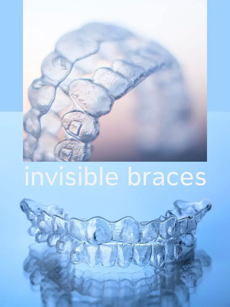 A close-up of a plastic braces that shows that you can get braces over.