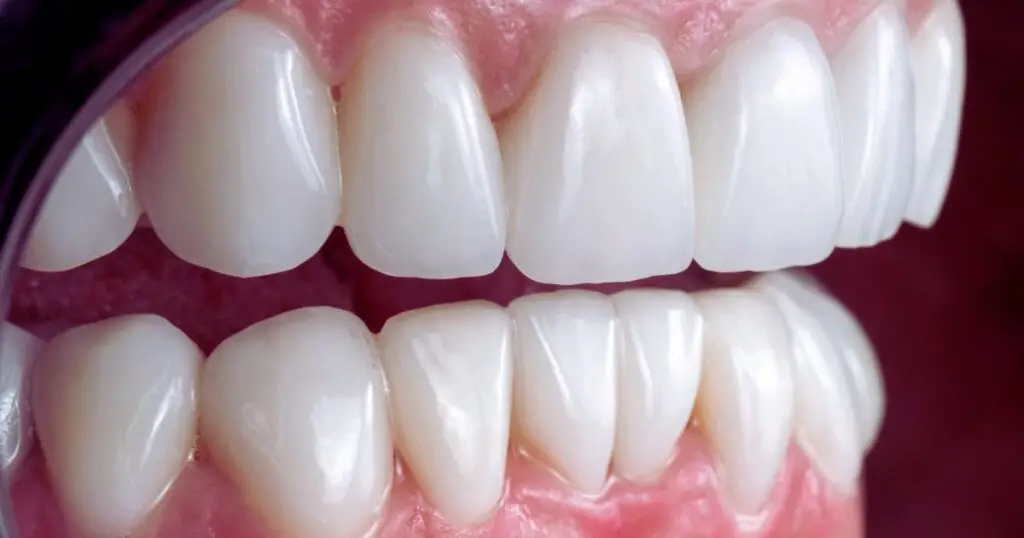 close up of teeth and gums to demonstrate whether veneers are bad for your teeth