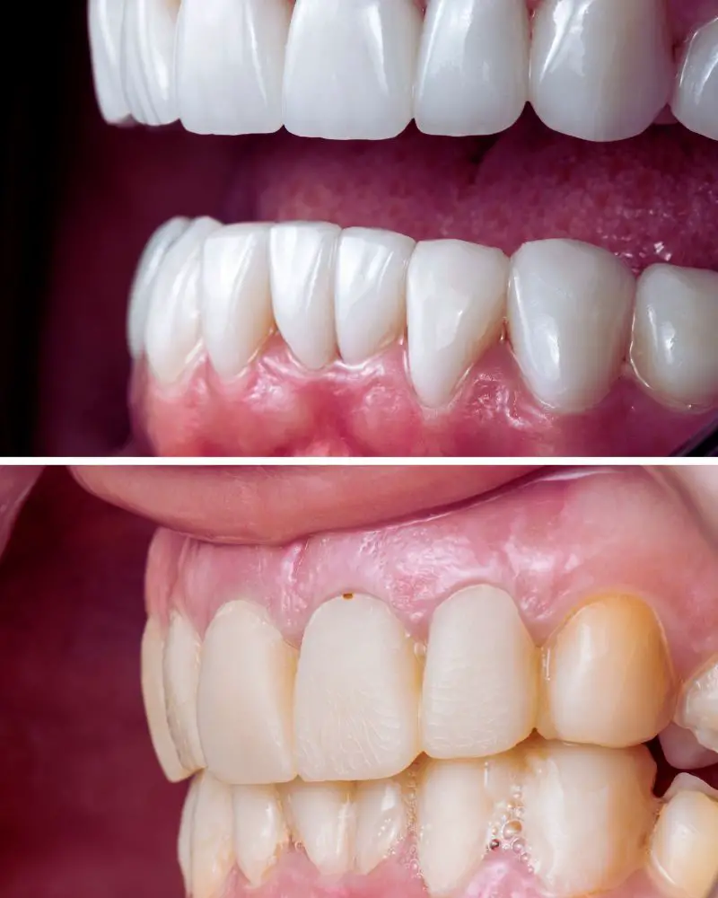 Before and after pictures of a set of yellow teeth that were transformed and whitened by permanent veneers