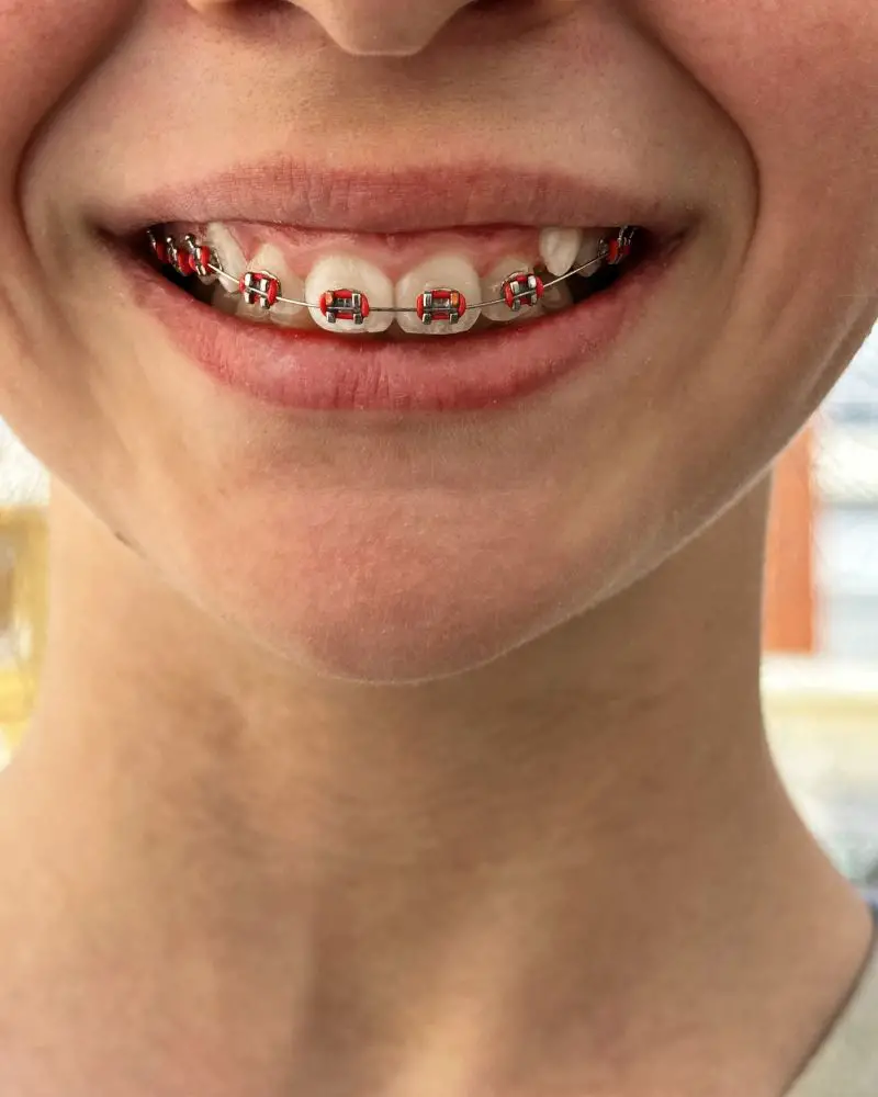 a person with braces on their teeth rather than invisalign for adults over 50